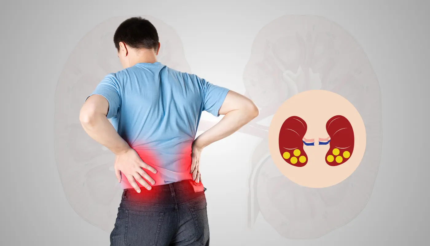 Kidney Stone Management Services in Hyderabad